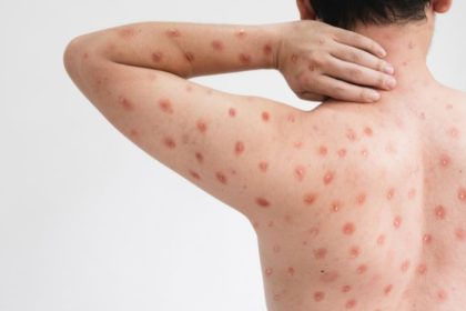 Cuiabá mantém vigilância ativa contra a mpox mesmo sem registros de casos